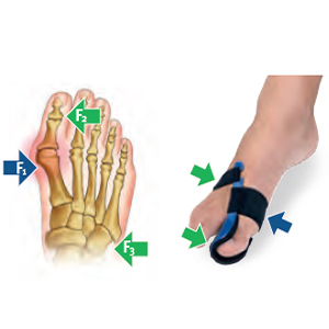 Бандаж при вальгусной деформации на левую ногу Orliman HV33I